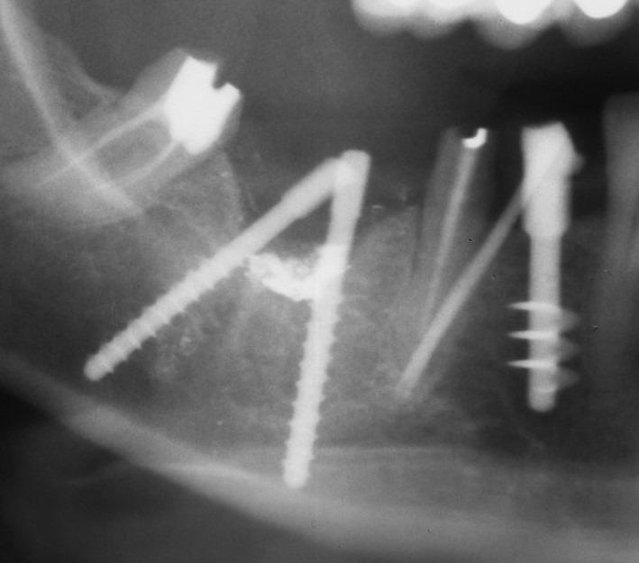 Bipode postestrattivo, appena inserito, realizzato per sostituire un impianto sepolto, rimosso per perimplantite.