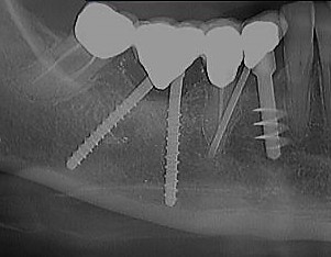 Controllo a sette anni di un bipode postestrattivo inserito dopo rimozione di un impianto sepolto in grave perimplantite, Si noti l'assenza di perdita ossea e addirittura di una ricrescita.