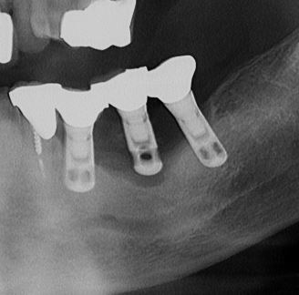 opt iniziale perimplantite gravissima del 36