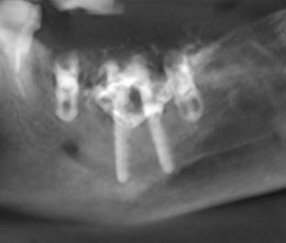 Controllo similpanoramico dei due impianti Tramonte posizionati e materiale riempitivo inserito