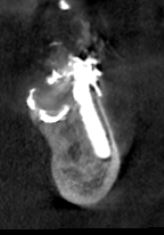 Sezine tomografica impianto Tramonte distale
