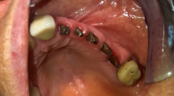 Condizioni della mucosa all'emergenza di impianti Tramonte