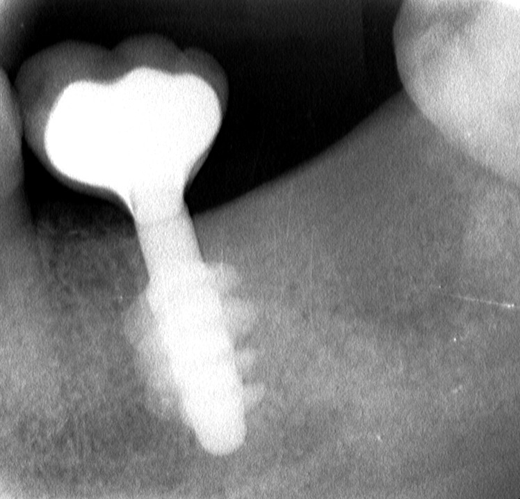 Il margine di chiusura protesica su impianti Tramonte