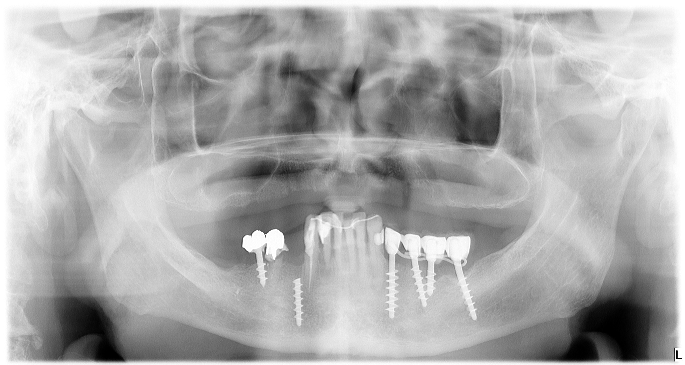 Impianto Tramonte spezzato